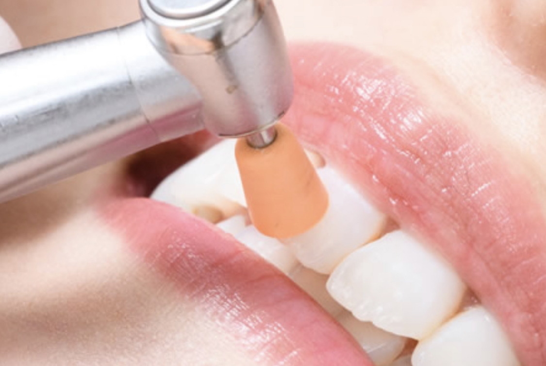 プロによるクリーニングPMTCを行っている画像